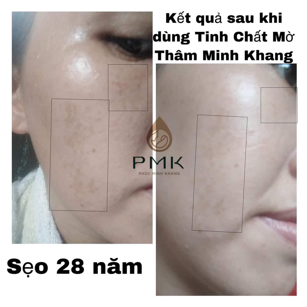 Tinh chất Xóa mờ thâm Minh Khang- Xoá thâm Sẹo,thâm mắt, thâm môi,thâm nách,thâm mụn,thâm gãi ngứa - Chính Hãng