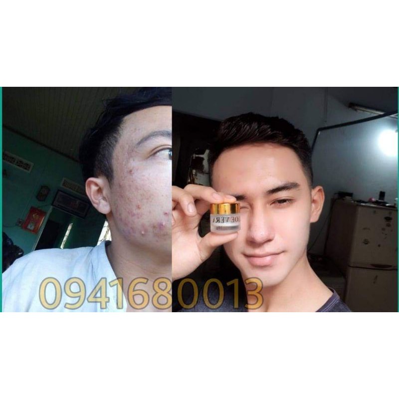Kem mụn Aloe Vera sạch mụn đầu đen,mụn bọc,mụn trứng cá, sạch thâm, phục hồi da sau mụn | BigBuy360 - bigbuy360.vn