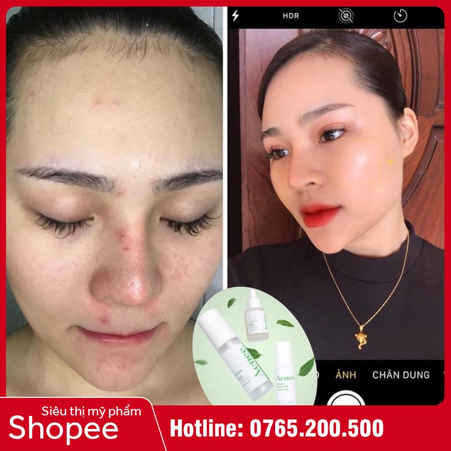 Acnee Serum - Serum chấm mụn LACO tràm trà & lá neem Acnee, giúp làm diu vùng da mụn | BigBuy360 - bigbuy360.vn