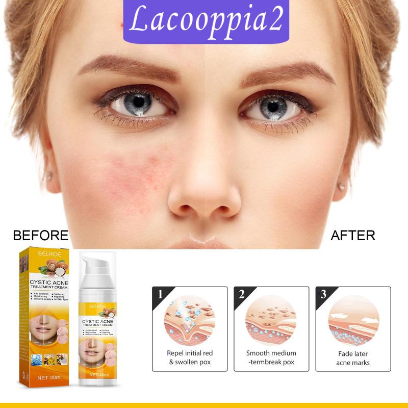 Kem Trị Mụn Lacooppia2 Làm Sáng Da Dịu Nhẹ