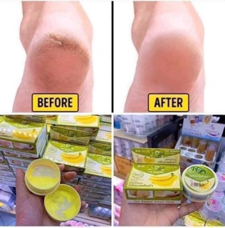 KEM TRỊ NỨT GÓT CHÂN CHUỐI