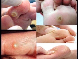 Miếng dán trị mắt cá, mụn cóc của nhật