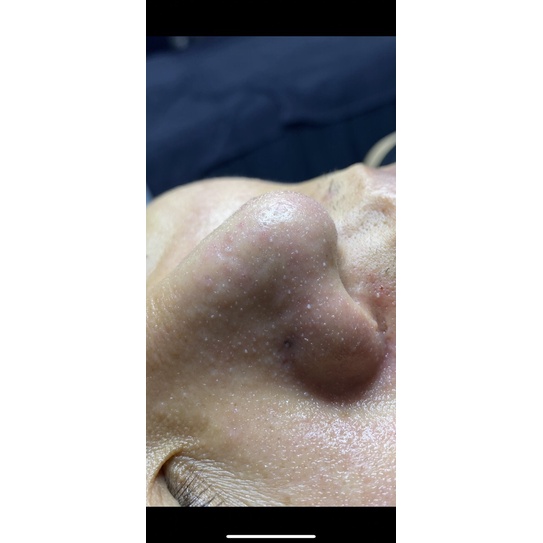 Ủ mụn đầu đen Medipeel 50ml