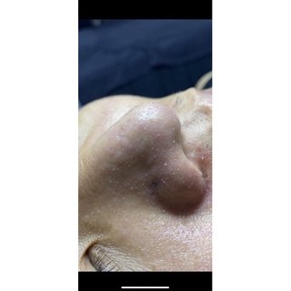 Ủ mụn đầu đen Medipeel 50ml