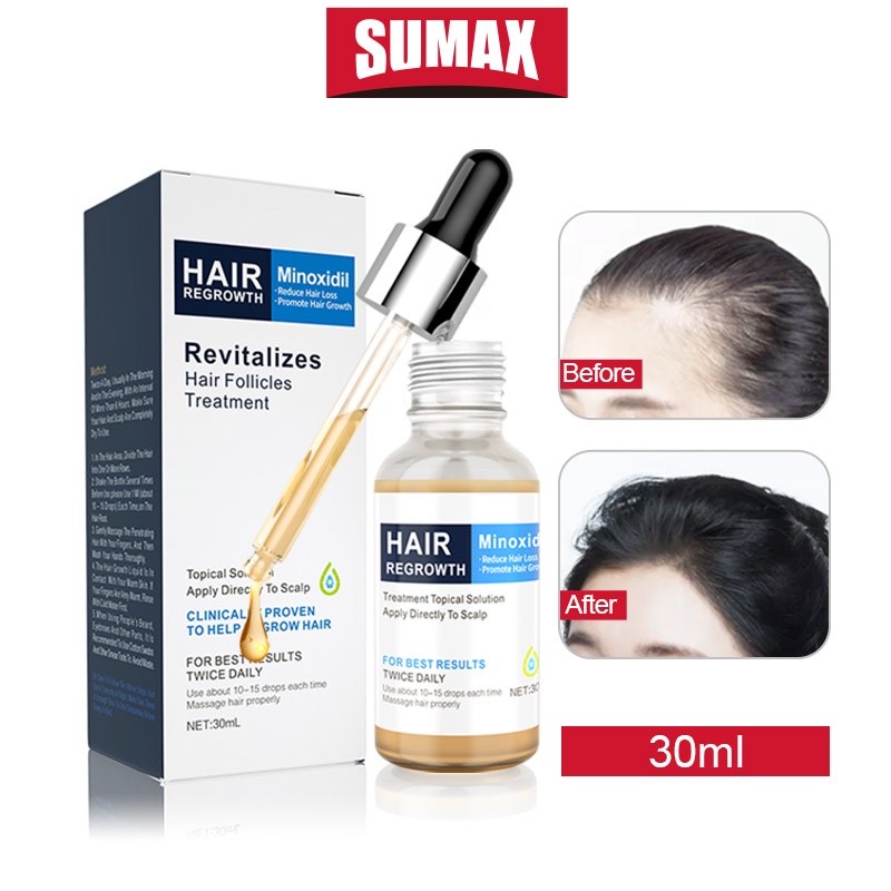 Tinh chất kích thích mọc tóc serum mọc tóc SUMAX 5% Minoxidil Giúp tóc mọc dày và chắc khỏe hơn 30ML