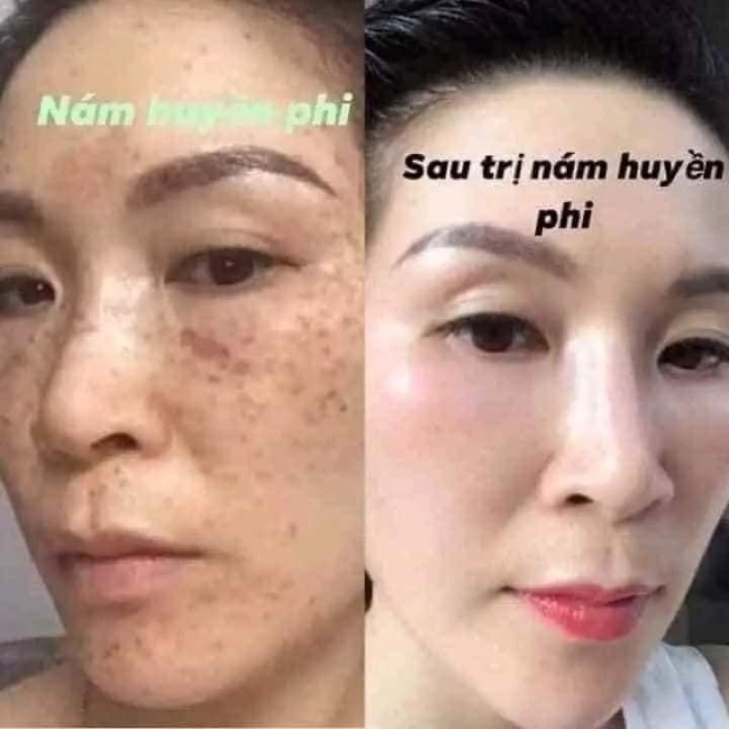 [CAM KẾT CHÍNH HÃNG] Kem Nám Huyền Phi 30g