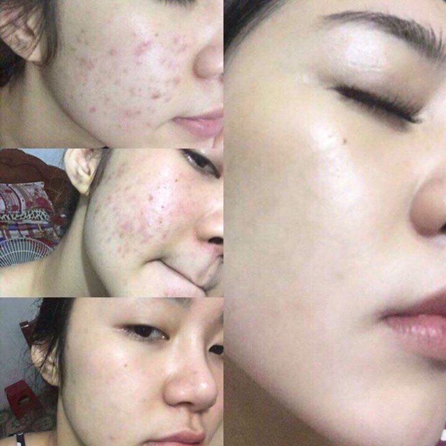 Tinh Chất Thay Da Sinh Học So’Natural Red Peel Tingle Serum