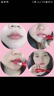 Cấy môi baby lips volume