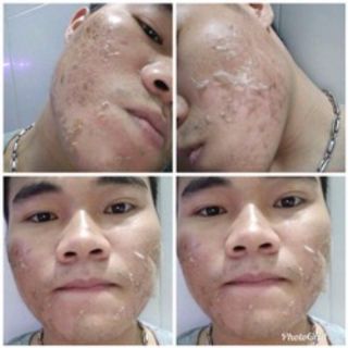 Piu Da Xóa Nám Sạm