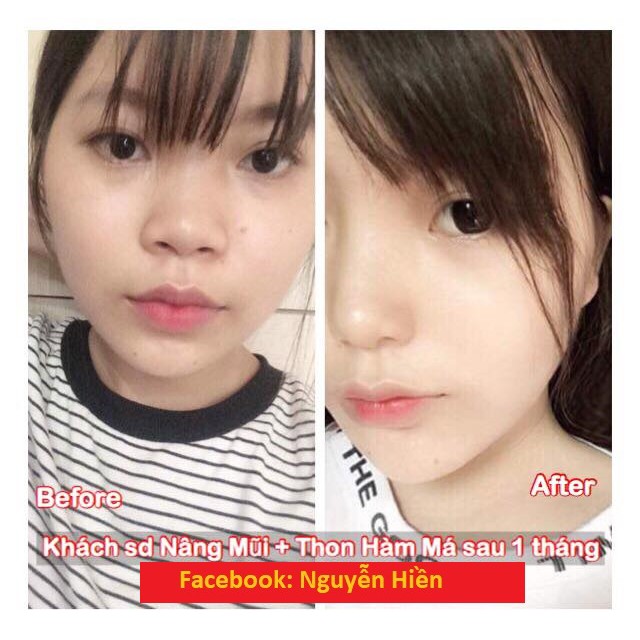 Tinh Chất Thon Gọn Mặt V-line Pháp