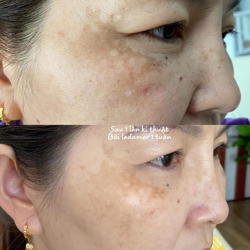 Bộ kem dưỡng trắng da giảm nám Ladamer Intensive Whitening Cream