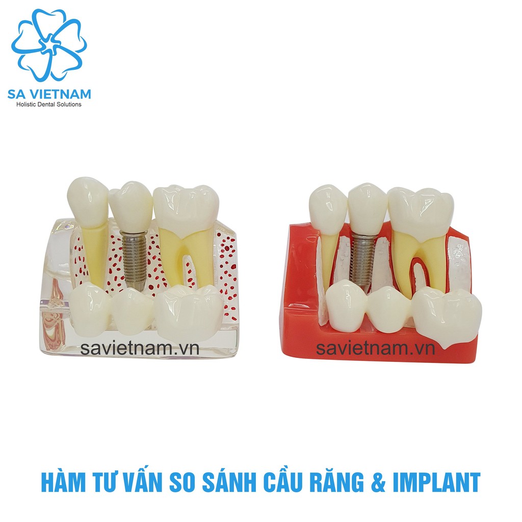 Mô hình hàm tư vấn so sánh cầu răng và implant - Mô hình răng thực hành nha khoa