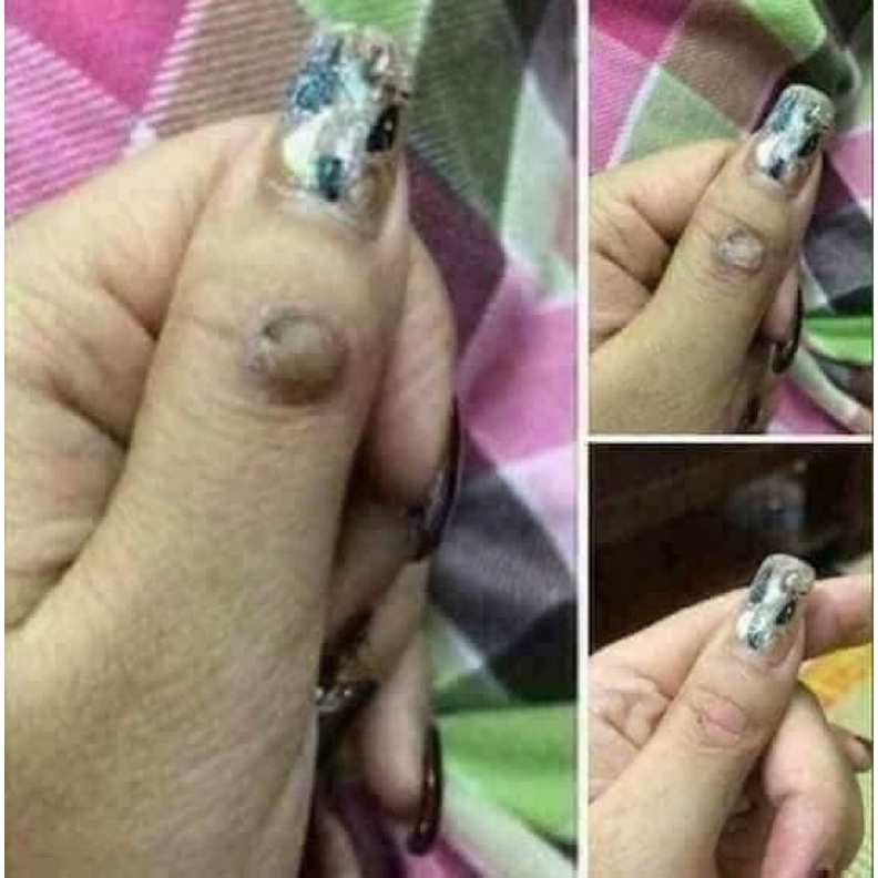 Gel tẩy mụn ruồi,mụn cóc, mụn cơm,tàn nhang | BigBuy360 - bigbuy360.vn