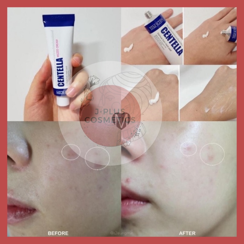 Kem Dưỡng Phục Hồi Cho Da Mụn Medi-Peel Centella Mezzo Cream 30ml | BigBuy360 - bigbuy360.vn