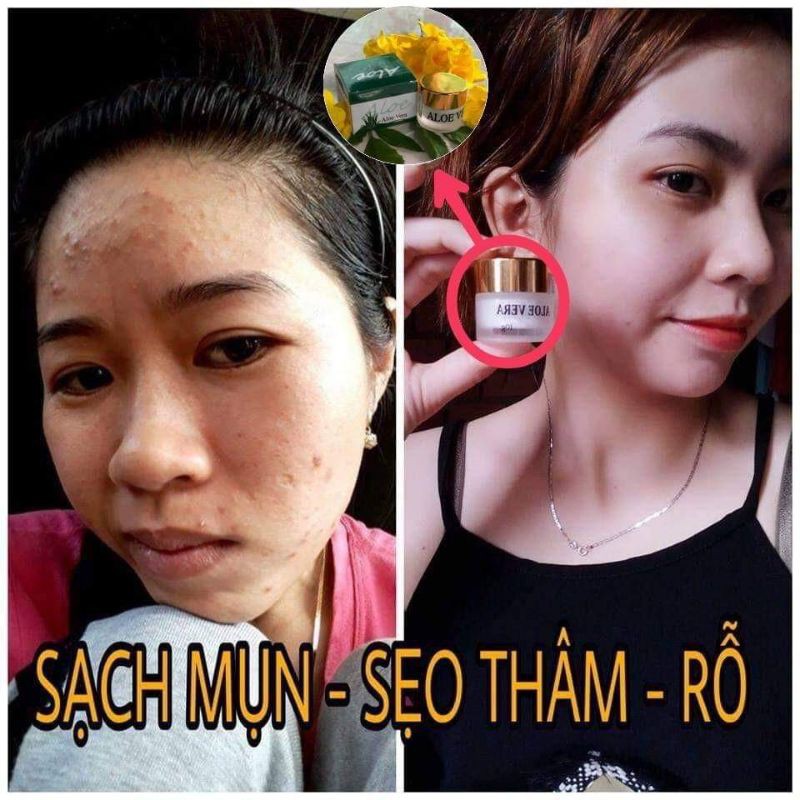 Kem mụn Aloe Vera sạch mụn đầu đen,mụn bọc,mụn trứng cá, sạch thâm, phục hồi da sau mụn | BigBuy360 - bigbuy360.vn