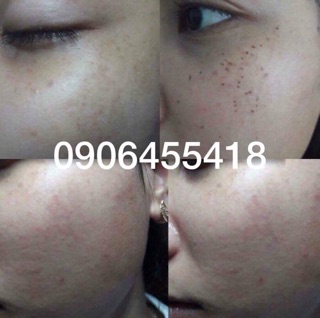 Chấm nám chân sâu , nám đinh