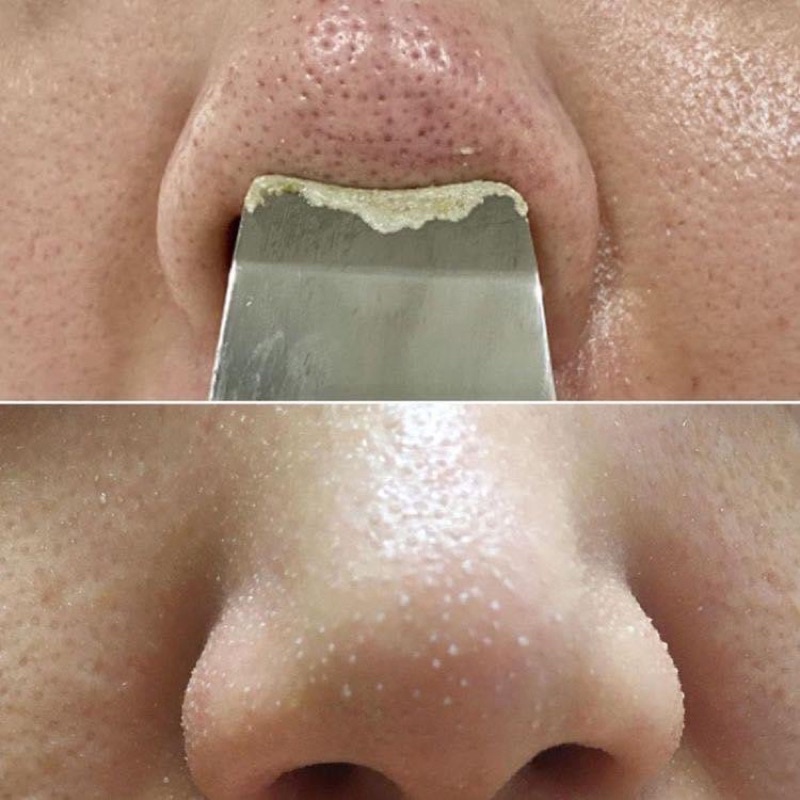 LOTION LÀM SẠCH MỤN ĐẦU ĐEN / MỤN CÁM