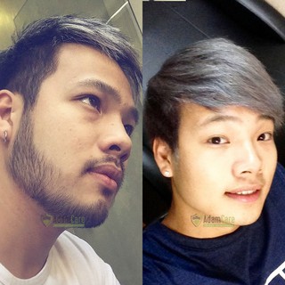 Combo 2 chai minoxidil 5% dạng Foam mọc râu tóc