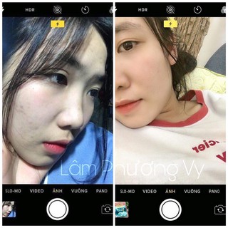 COMBO SERUM HUNIE { CAM KẾT HÀNG CHÍNH HÃNG }