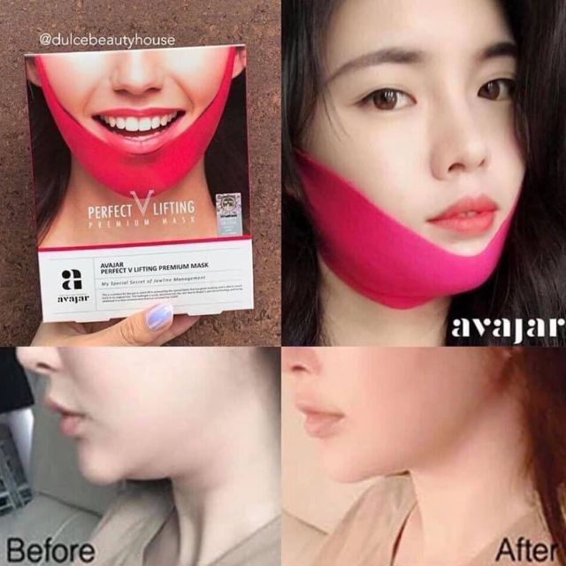 Tạo hình Vline ko cần phẫu thuật