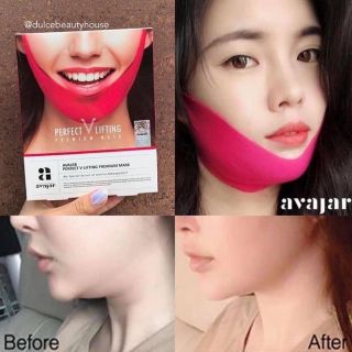 Tạo hình Vline ko cần phẫu thuật