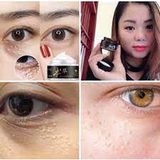 Kem mụn thịt quanh mắt ( cam kết chuẩn 100%)