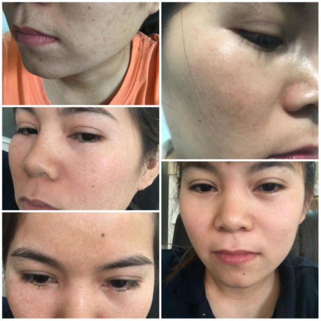 Thuốc Bắc Handmade Tái Tạo Da - Serum Giảm Mụn Thâm Rỗ - Đánh Bay Tất Cả Các Loại Mụn, Mờ Nám, Tàn Nhan | BigBuy360 - bigbuy360.vn