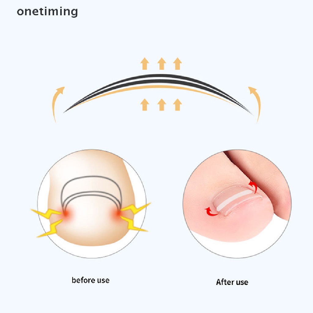 Bộ 10 Miếng Dán Đàn Hồi Chỉnh Sửa Móng Chân Mọc Ngược