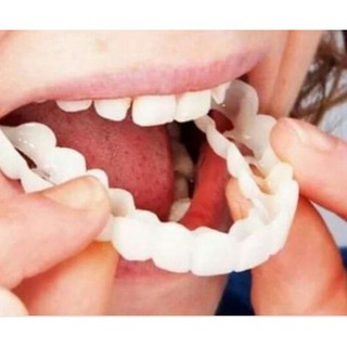 Nẹp răng Snapon Smile