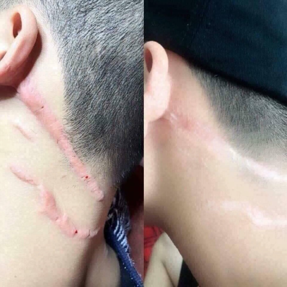 Kem Sẹo Nga, Kem Mờ Mẹo Thâm, Toại Bỏ Sẹo Lồi Lõm,Rạn Da Chỉ Trong 2 Tháng Với Klirvin