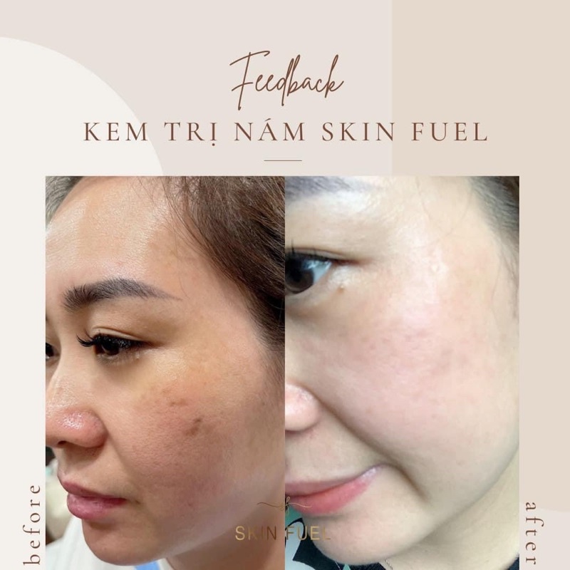 Kem trị nám trắng da Skin Fuel