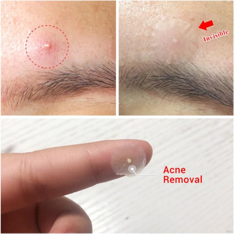 [Hàng mới về] Lanbena Miếng dán mụn dùng để che khuyết điểm làm đẹp hoặc trang điểm | BigBuy360 - bigbuy360.vn
