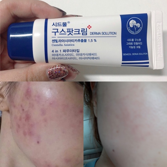 Kem dưỡng da mụn Sidmool centella good spot cream