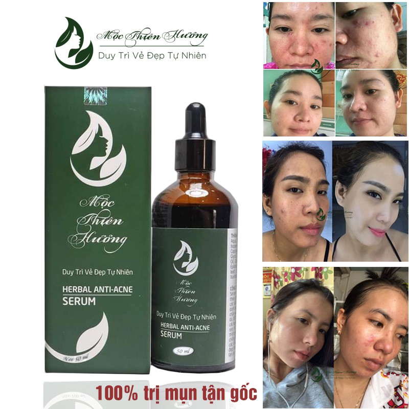 Serum Xóa Mụn Sạch Thâm Tái Tạo, Trắng Da - Herbal Anti Acne Serum 50ml Mộc Thiên Hương