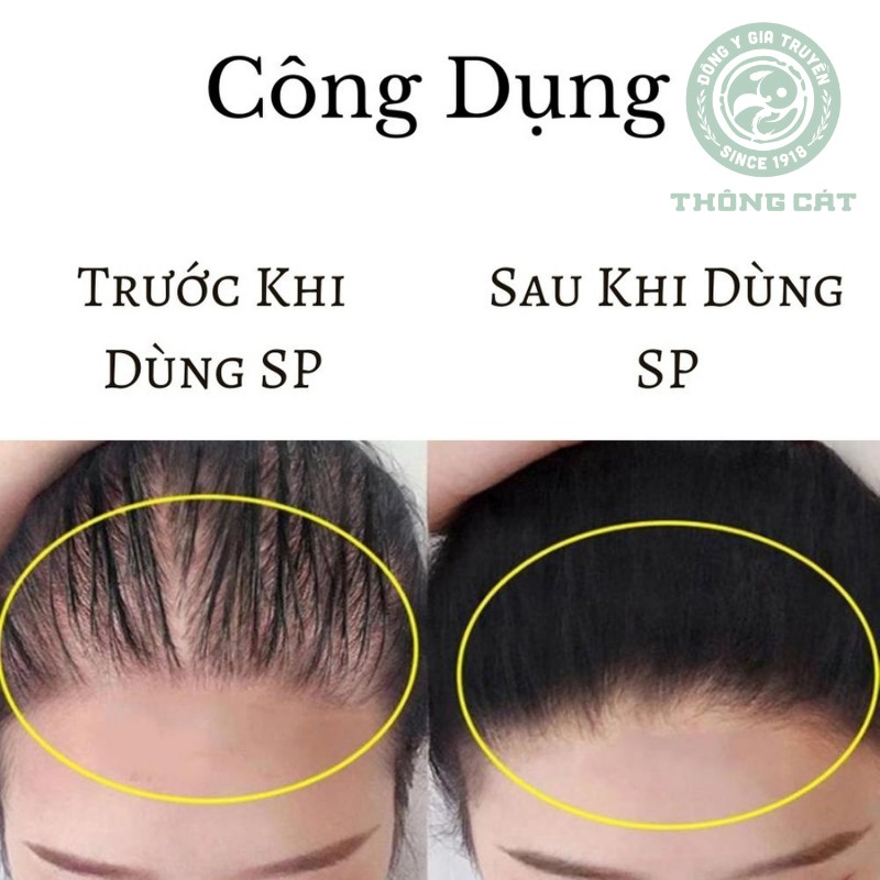 Thuốc mọc tóc Đông y gia truyền Thông Cát hiệu quả đến bất ngờ-mọc tóc nhanh chỉ sau vài lần sử dụng