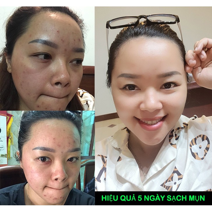 Serum Tri Mun Bọc-Mun Đầu Đen V9Queen-TRI MUN ẨN-TRI THÂM | BigBuy360 - bigbuy360.vn