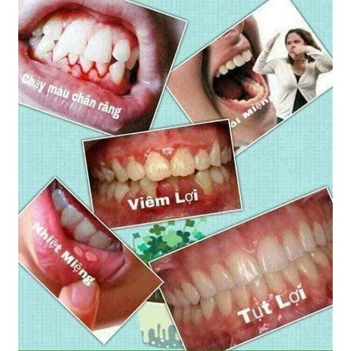 Bột trắng răng than hoạt tính MY SMILE - Khử Mùi và Chống Vàng Răng - Bạn vui lòng video hướng dẫn làm trắng