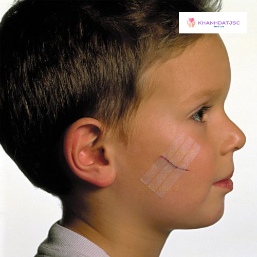 Băng vô trùng thay chỉ khâu Urgostrips 100mm x 6mm