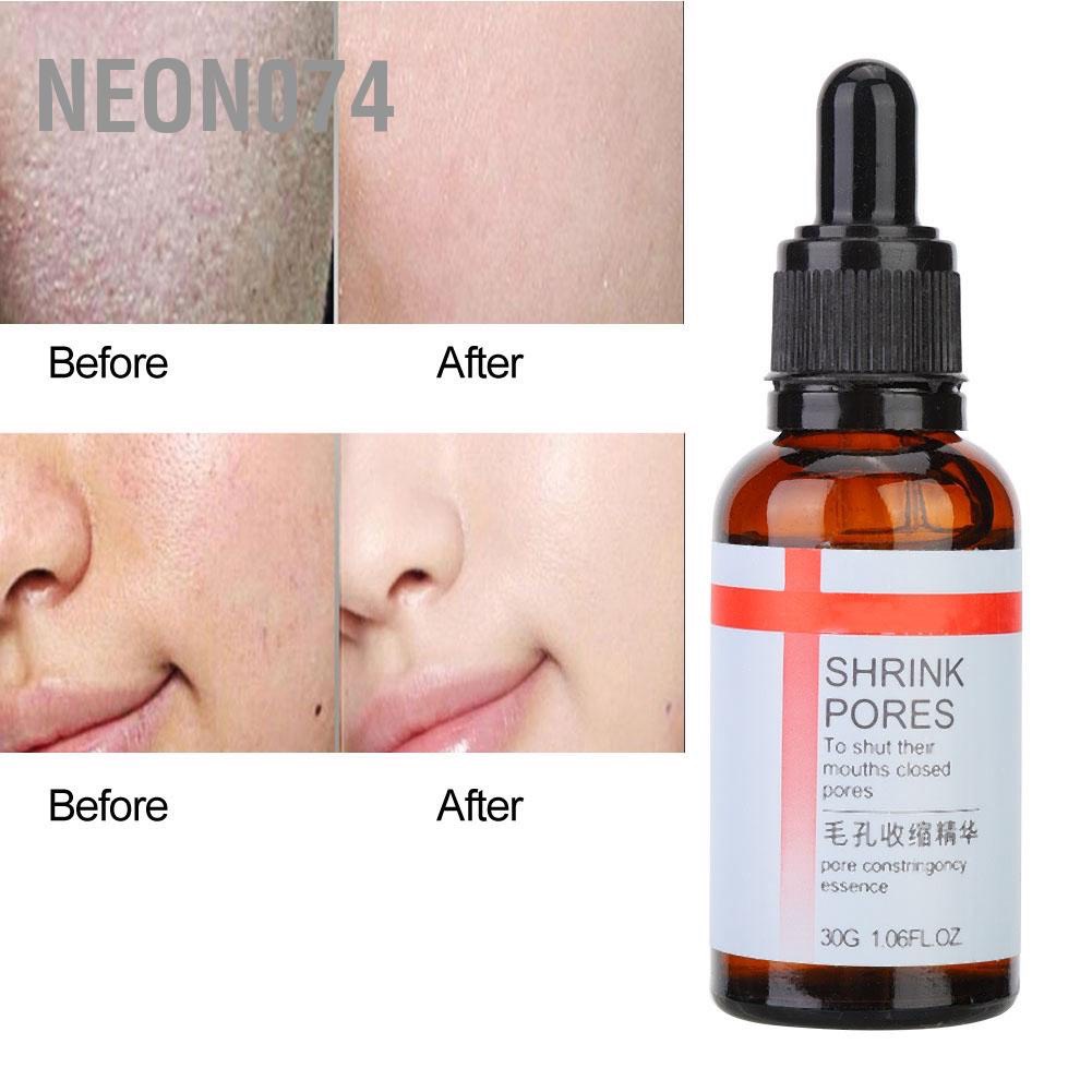 (ĐẸP+) Tinh chất dưỡng ẩm se khít lỗ chân lông loại bỏ mụn đầu đen cho da mụn, da dầu, kiểm soát nhờn