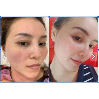 Kem trị nám NACOS