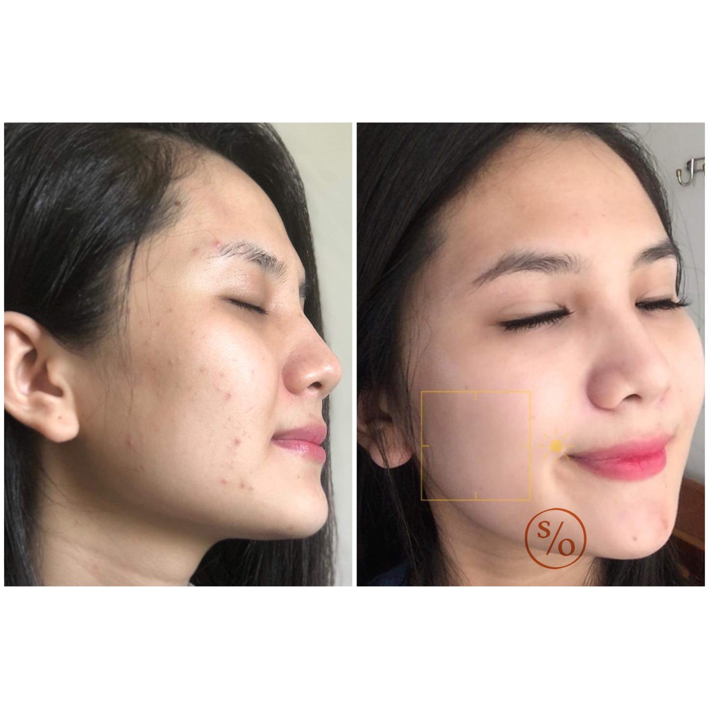 GIẢI PHÁP NGỪA MỤN NÁM SẸO RỖ TÁI TẠO LÀN DA MỚI SKIN RENEWAL SOLUTION BẰNG THẢO DƯỢC DÀNH CHO MỌI LOẠI DA | BigBuy360 - bigbuy360.vn
