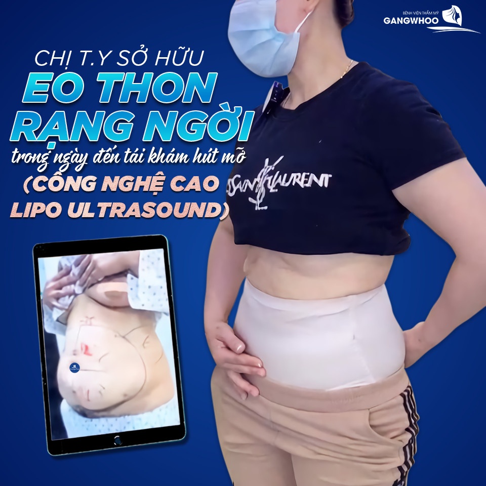 Giảm mỡ bụng Lipo Ultrasound tại Gangwhoo