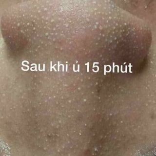 Ủ mụn đầu đen, mụn cám YOUNGER