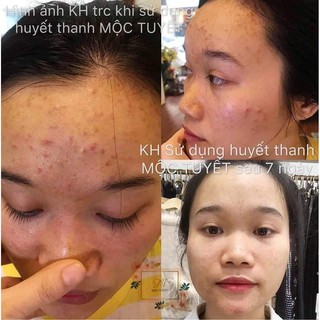 HUYẾT THANH MỘC TUYẾT [ KÈM VIDEO CHECK CHÍNH HÃNG][VIDEO]