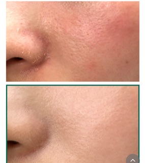 TONER AHA – BHA – PHA Miracle SOME BY MI