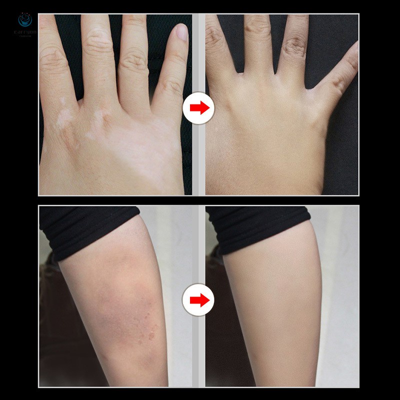 [Hàng mới về] Set 2 Kem Che Khuyết Điểm Che Phủ Vết Sẹo / Hình Xăm / Vết Rạn Da | BigBuy360 - bigbuy360.vn