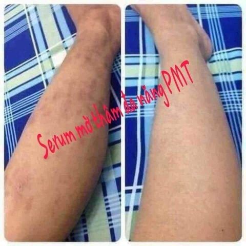 Serum mờ thâm đa năng PMT - Serum mờ thâm Phúc Minh Tâm