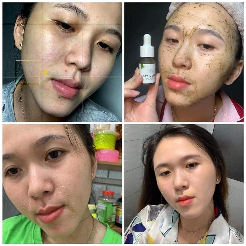 LE’PEAU peel vi tảo