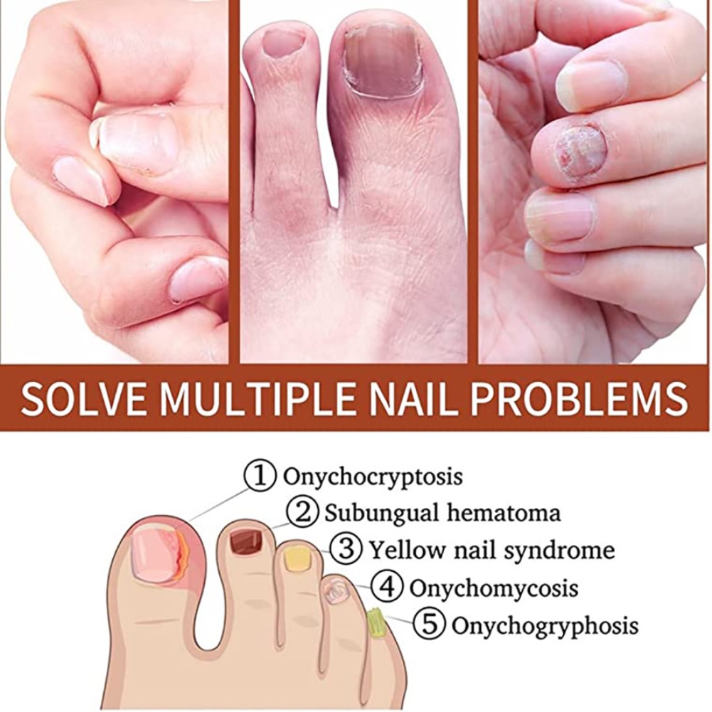 Ibealee Kháng Khuẩn Đặc Biệt Chất Lỏng Cho Onychomycosis Loại Bỏ Móng Kem Làm Dày Mềm Mại Móng Onychomycosis Okase