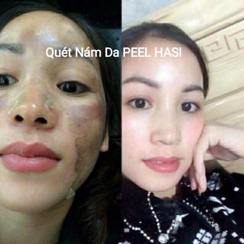 Chấm Đầy SẸO RỖ Lâu Năm. Quét Nám Tàn Nhang Peel HA SI